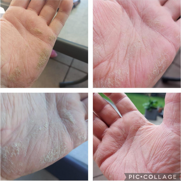 Die Fotos der Anwender bestätigen eine Hautverbesserung bei regelmäßier Anwendung. Rissige, schuppige Handflächen bekommt ein verbessertes Hautbild. Die Haut sieht gesünder aus.