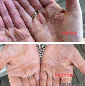 Die Fotoszeigen oben extrem rissige und schuppige Handflächen. Die Haut sieht sehr rau und rissig aus. Nach der Behandlung sehen die Hände auf den Bildern weniger trocken, deutlich glatter und insgesamt gepflegter und gesünder aus. 