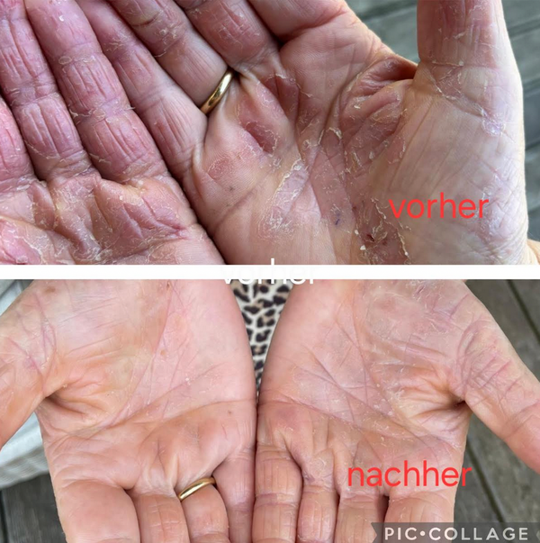 Die Fotoszeigen oben extrem rissige und schuppige Handflächen. Die Haut sieht sehr rau und rissig aus. Nach der Behandlung sehen die Hände auf den Bildern weniger trocken, deutlich glatter und insgesamt gepflegter und gesünder aus. 